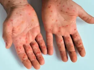 Чем опасен вирус Коксаки