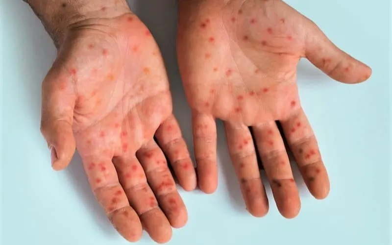 Чем опасен вирус Коксаки